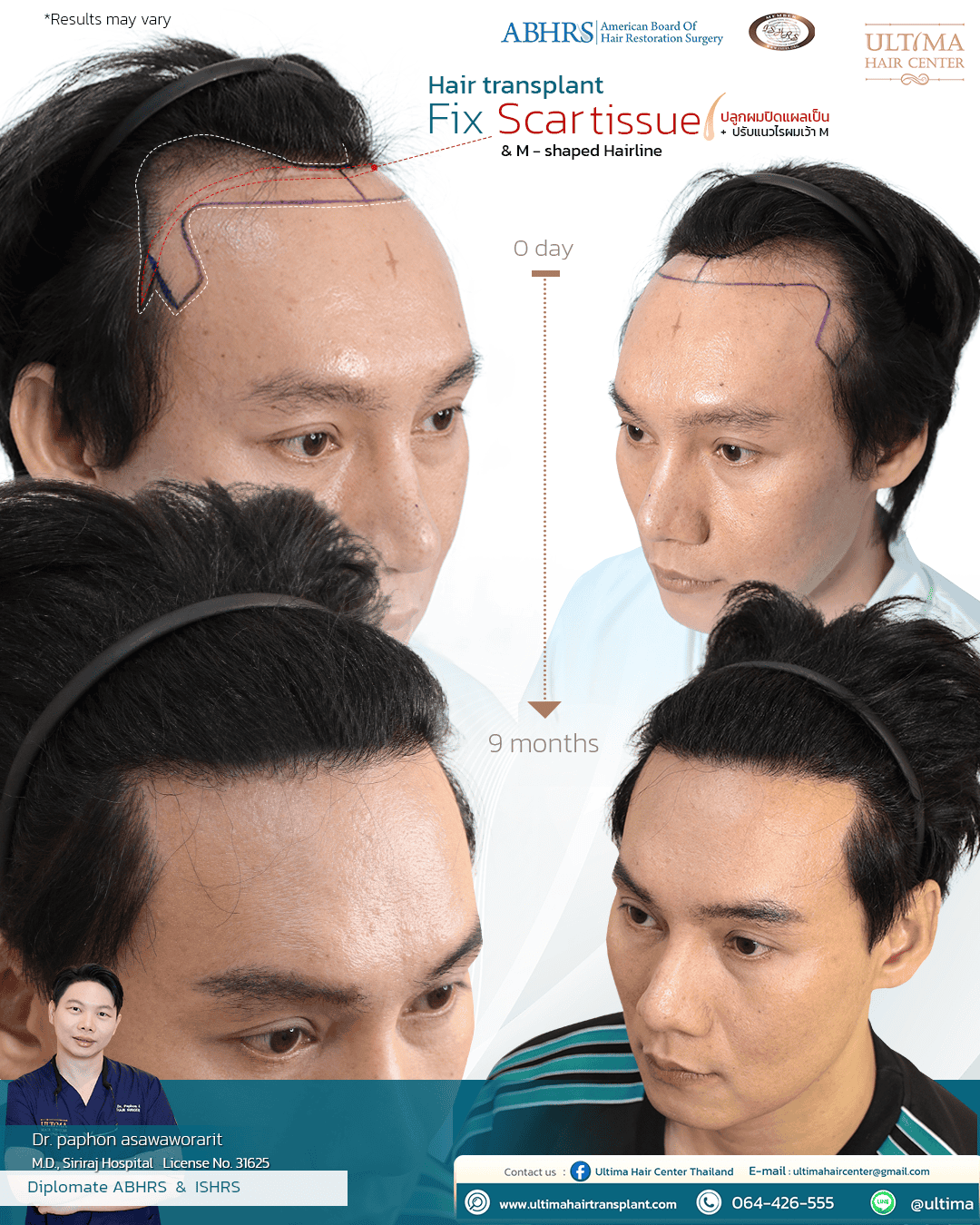 scar repair hair transplant