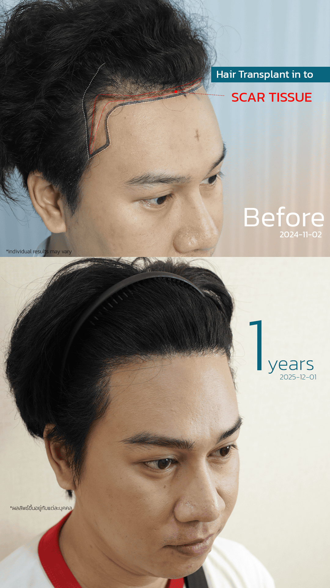 scar repair hair transplant
