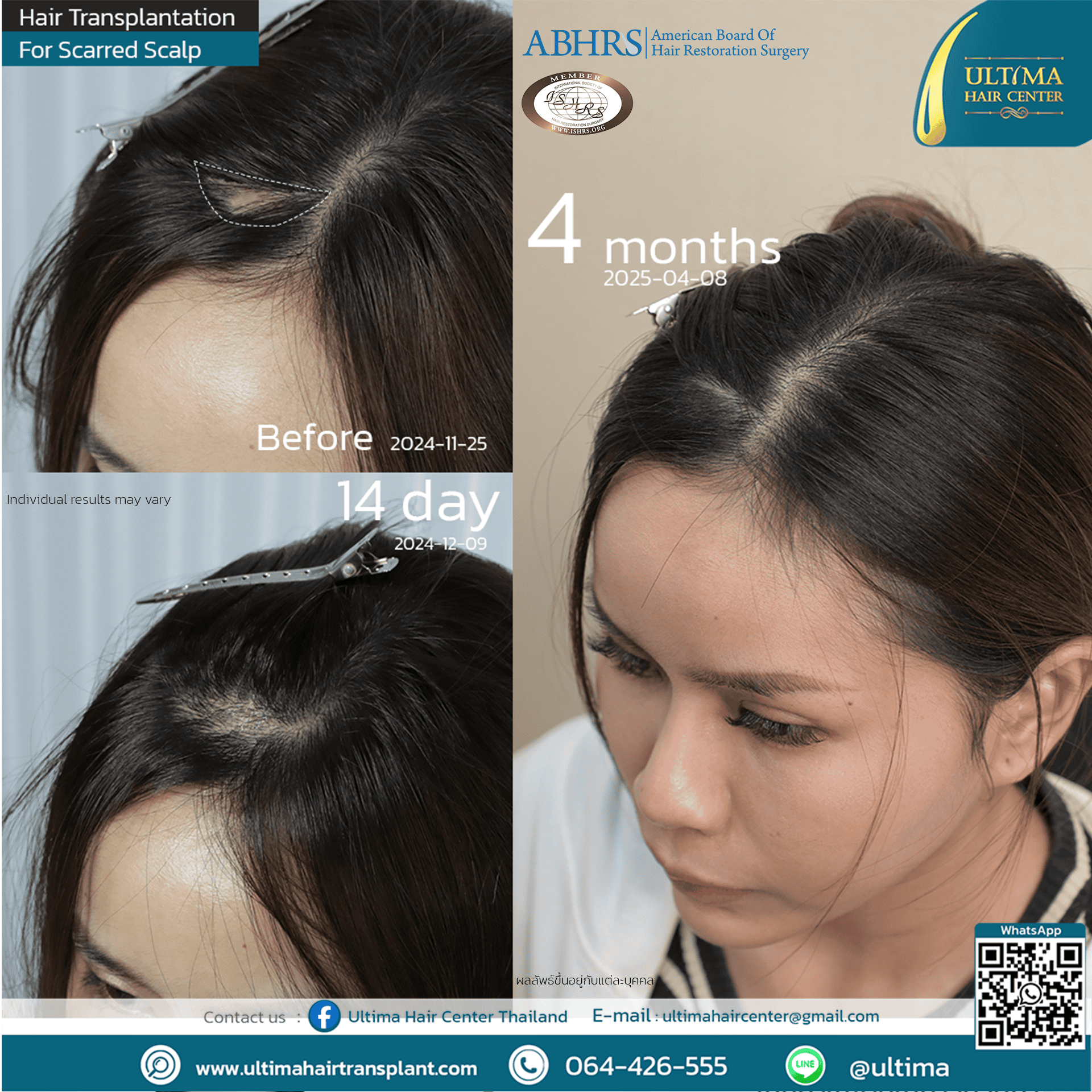 scar repair hair transplant