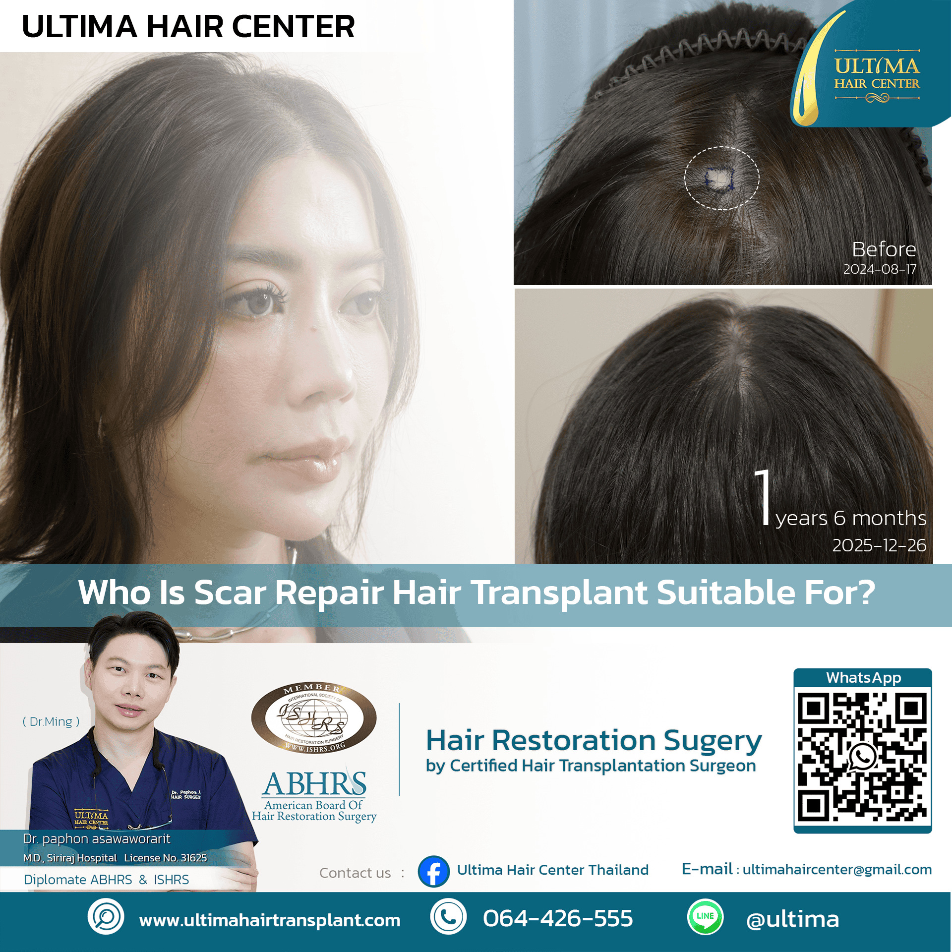 scar repair hair transplant