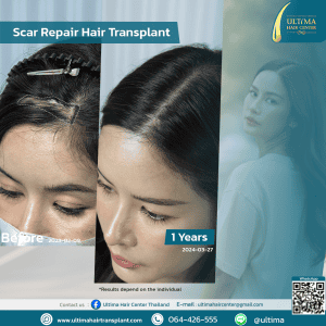 Hair Transplant Bangkok
