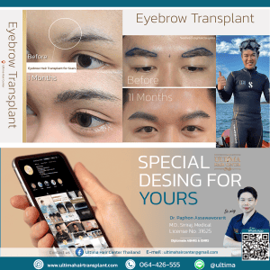 Hair Transplant Bangkok