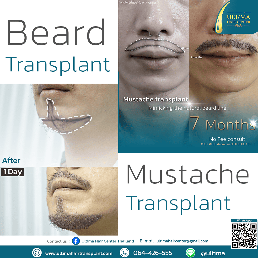 hair transplant bangkok