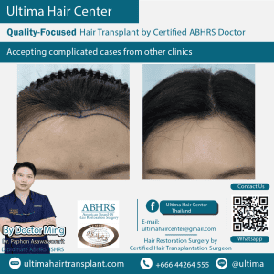 woman hair transplant