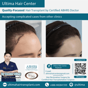 woman hair transplant
