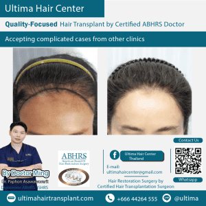 woman hair transplant