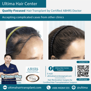 woman hair transplant