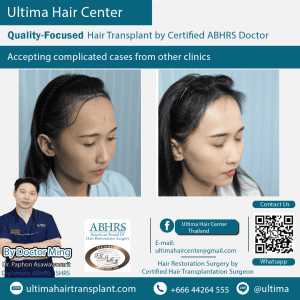 woman hair transplant