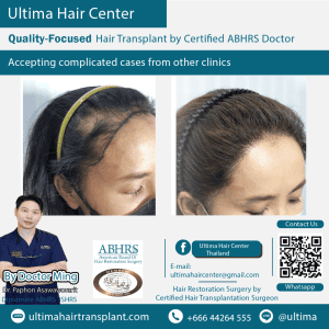woman hair transplant