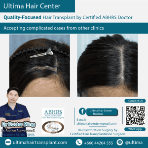 woman hair transplant