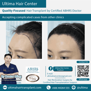 woman hair transplant