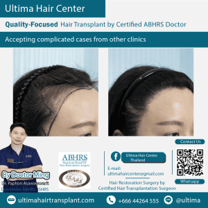 woman hair transplant