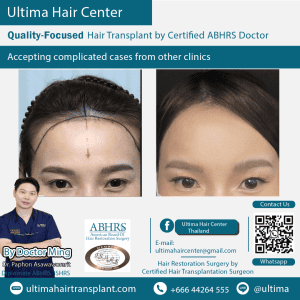 woman hair transplant