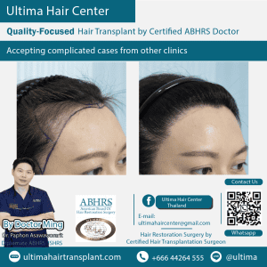 woman hair transplant