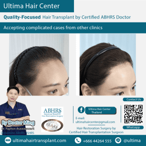 woman hair transplant