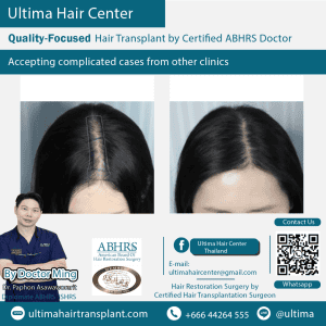 woman hair transplant