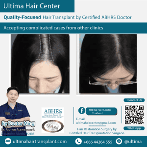 woman hair transplant