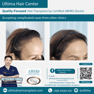 woman hair transplant