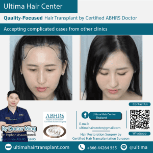 woman hair transplant
