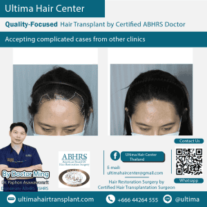 woman hair transplant