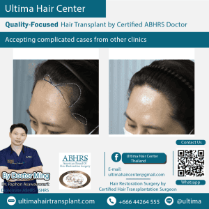 woman hair transplant