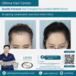 woman hair transplant