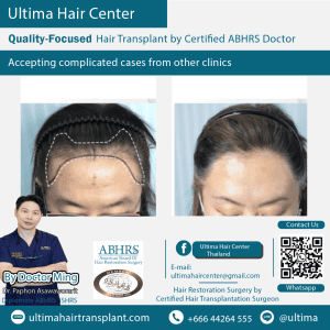 woman hair transplant
