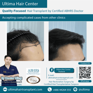 man hair transplant