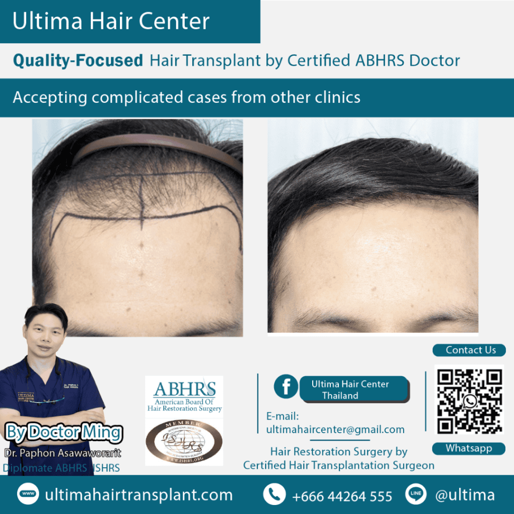 hair transplant bangkok
