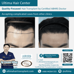 man hair transplant