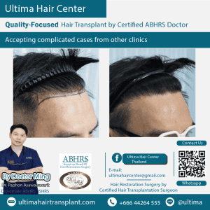 man hair transplant