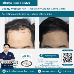 man hair transplant
