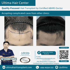man hair transplant