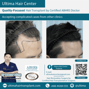 man hair transplant