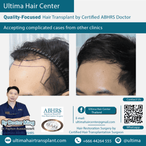 man hair transplant