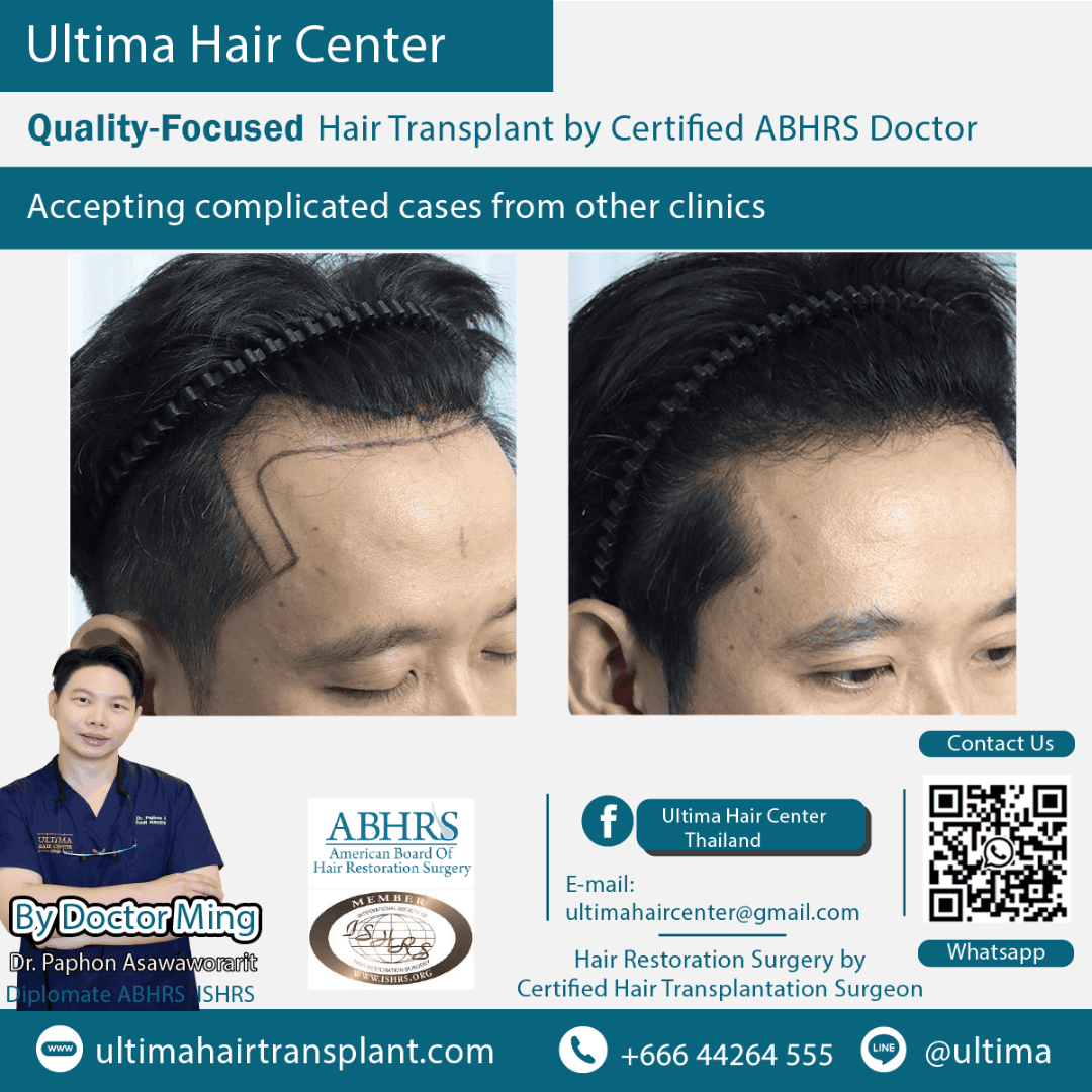 How many days after hair transplant can I wash my hair