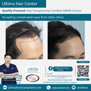 man hair transplant