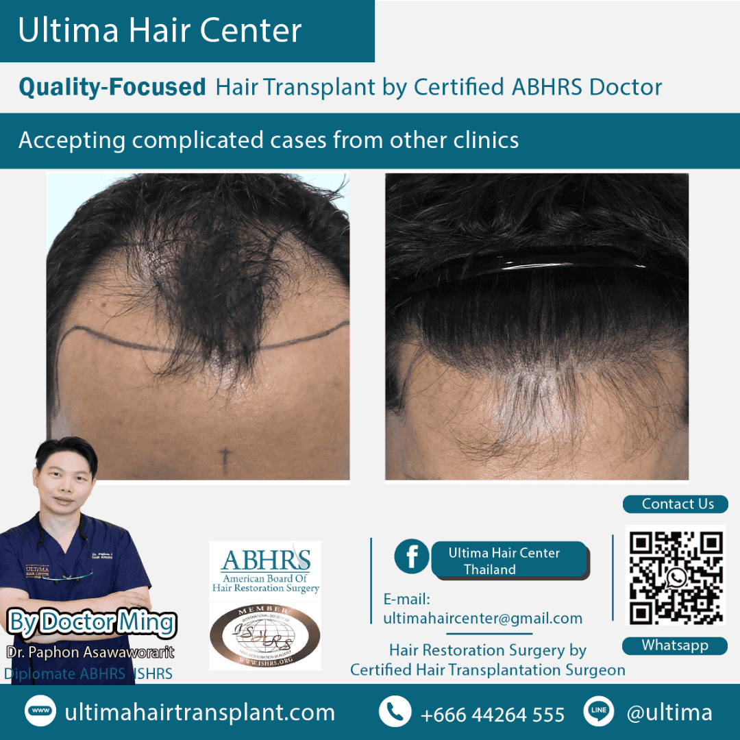 How many days after hair transplant can I wash my hair