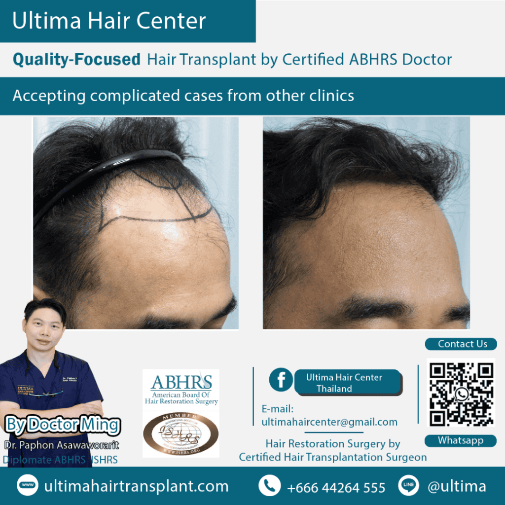 hair transplant bangkok