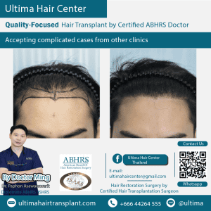 man hair transplant