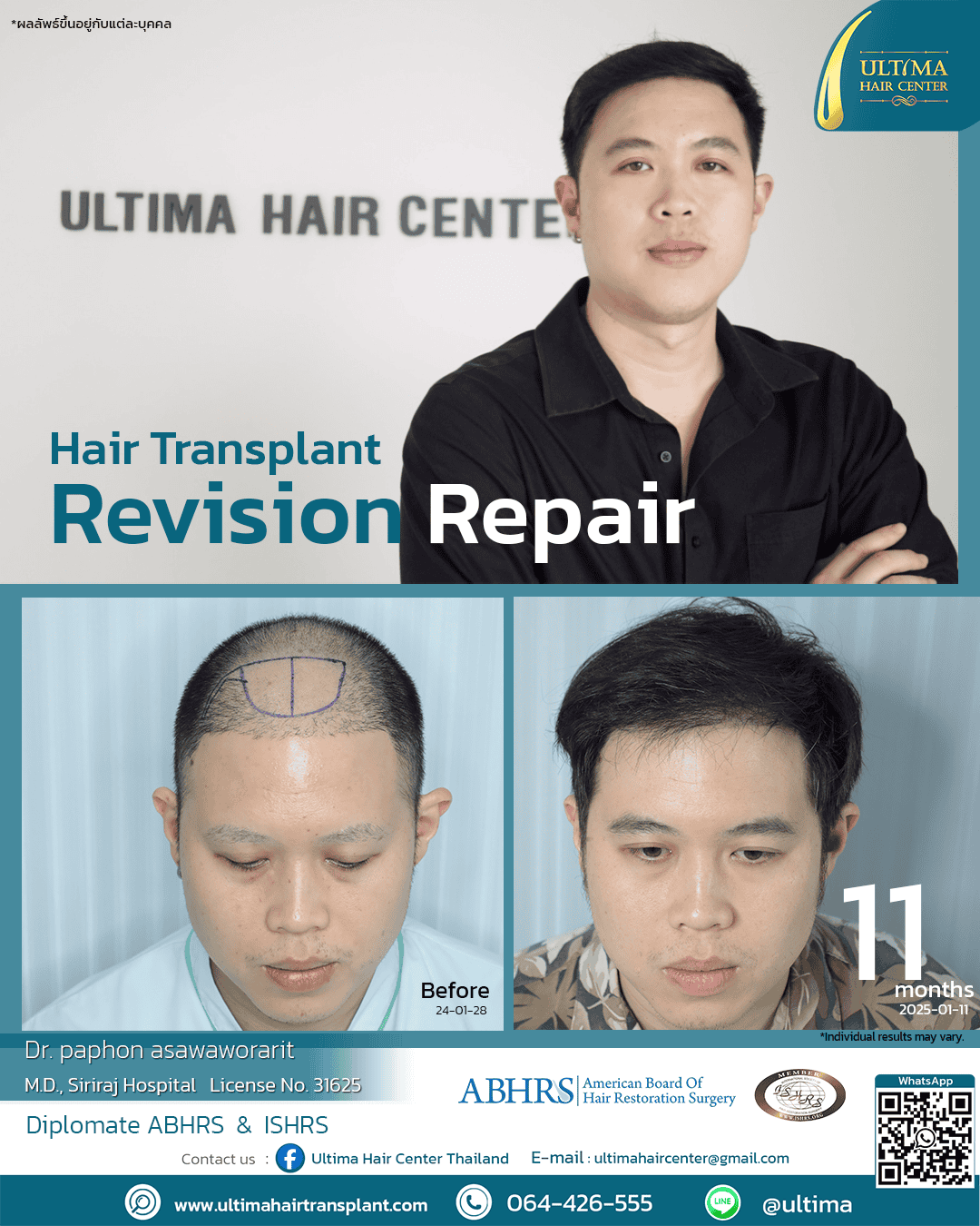 Hair transplant revision