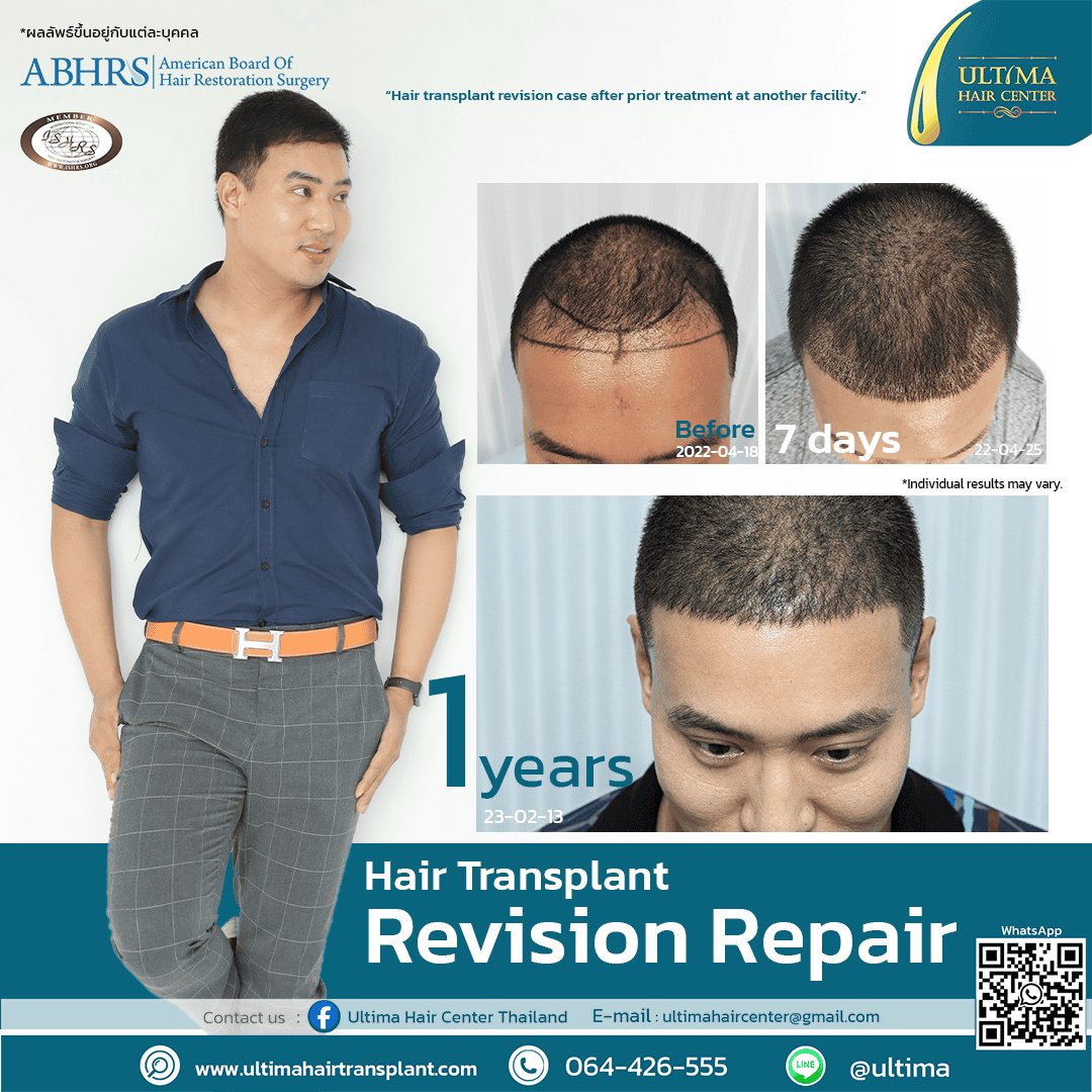 Hair transplant revision