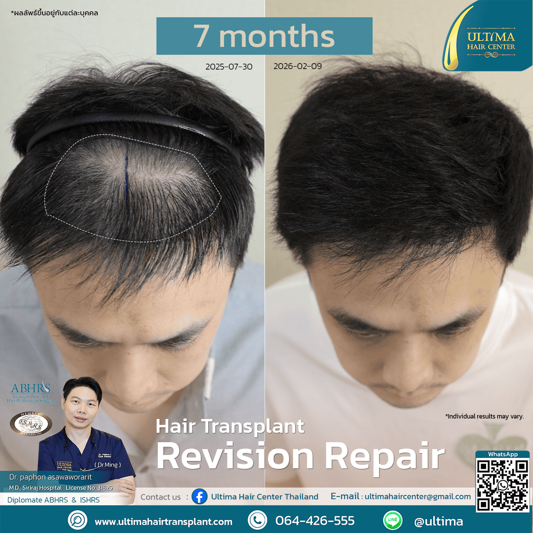 Hair transplant revision