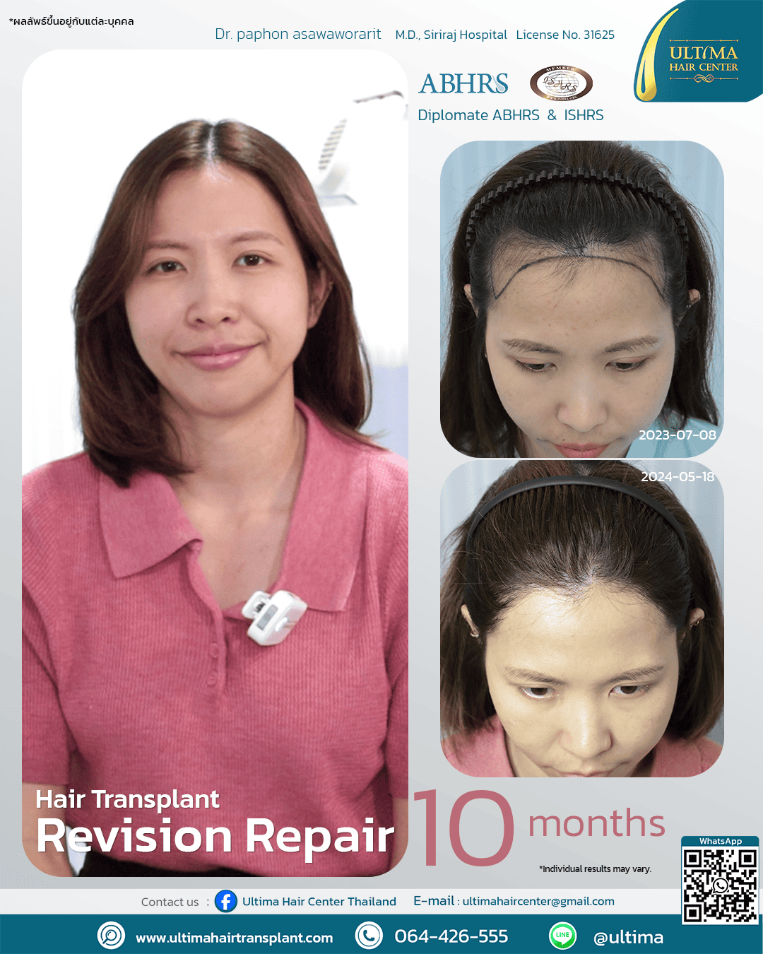 Hair transplant revision