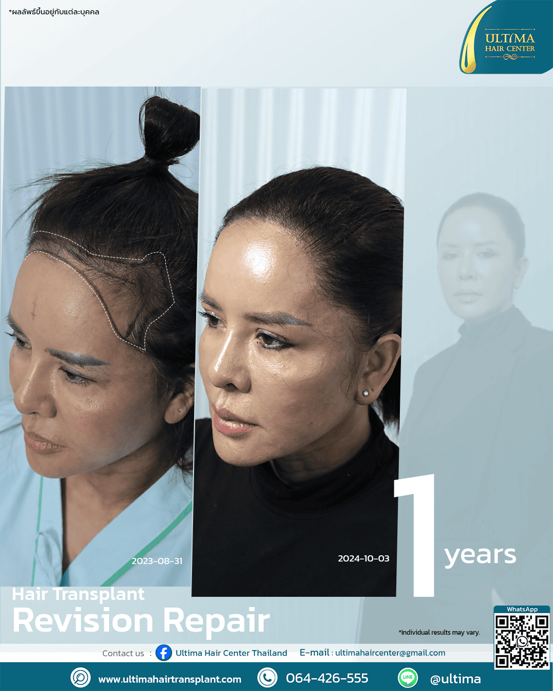 Hair transplant revision