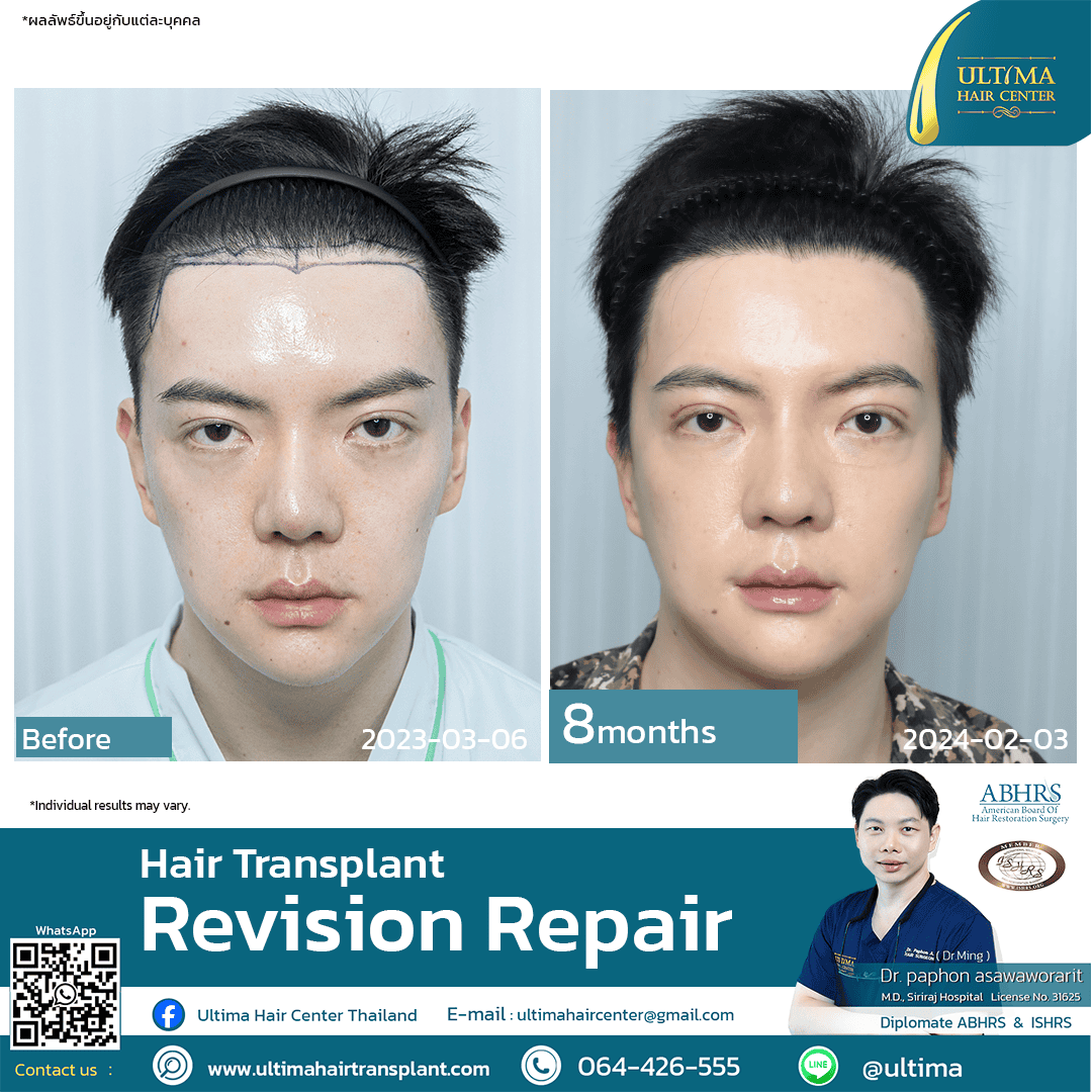Hair transplant revision