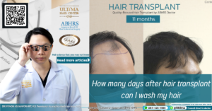 How many days after hair transplant can I wash my hair