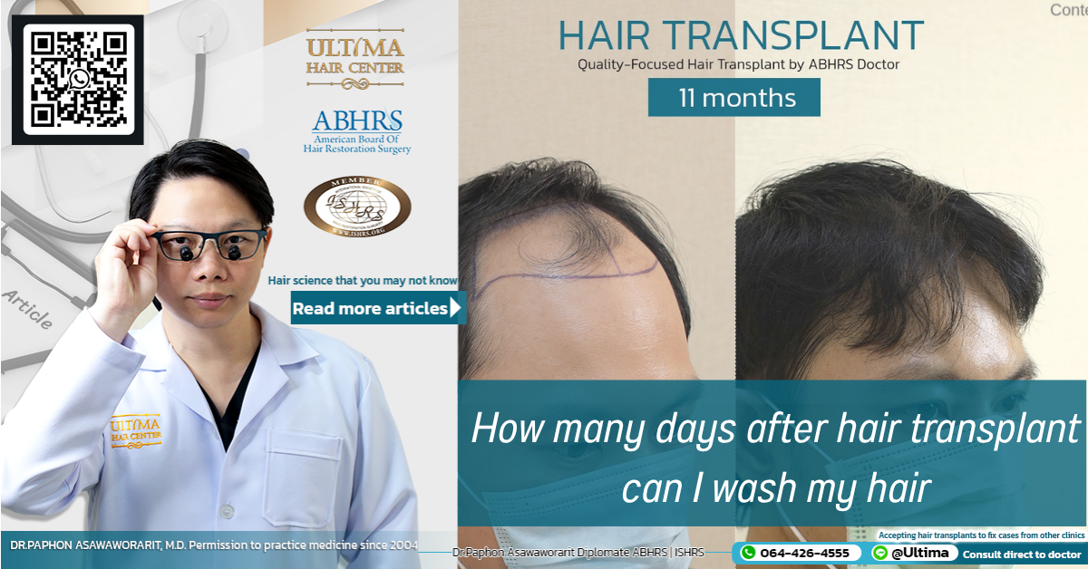 How many days after hair transplant can I wash my hair How many days after hair transplant can I wash my hair