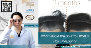 What Should You Do If You Want a Hair Transplant