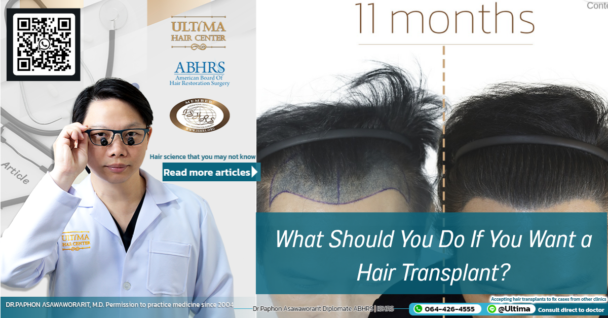 What Should You Do If You Want a Hair Transplant What Should You Do If You Want a Hair Transplant